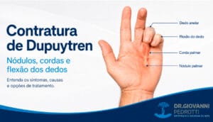 Ilustração da Contratura de Dupuytren mostrando nódulo palmar, corda na palma da mão e flexão dos dedos anelar e mínimo.