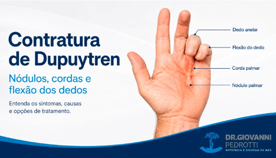 Ilustração da Contratura de Dupuytren mostrando nódulo palmar, corda na palma da mão e flexão dos dedos anelar e mínimo.