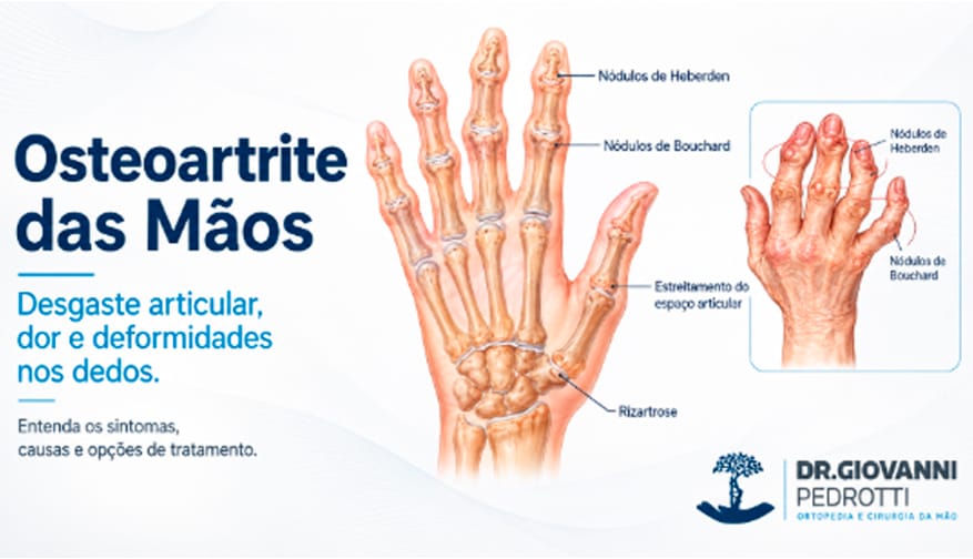 Ilustração anatômica da osteoartrite das mãos mostrando nódulos de Heberden, nódulos de Bouchard, estreitamento do espaço articular e rizartrose.
