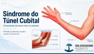Ilustração anatômica da Síndrome do Túnel Cubital mostrando compressão do nervo ulnar no cotovelo e área de formigamento no antebraço e dedos.