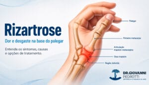 Ilustração anatômica da rizartrose mostrando desgaste na articulação trapézio-metacárpica, na base do polegar.