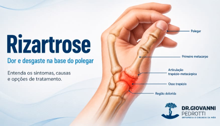 Ilustração anatômica da rizartrose mostrando desgaste na articulação trapézio-metacárpica, na base do polegar.