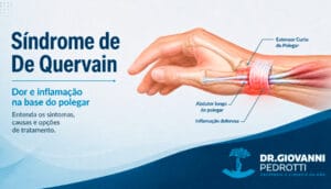 Ilustração anatômica da Síndrome de De Quervain mostrando inflamação dos tendões extensor curto e abdutor longo do polegar.