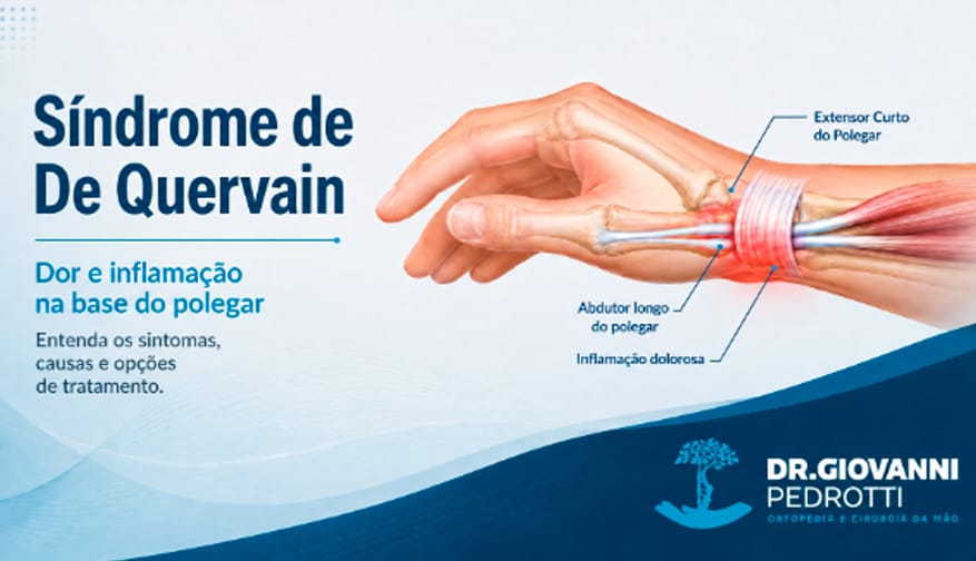 Ilustração anatômica da Síndrome de De Quervain mostrando inflamação dos tendões extensor curto e abdutor longo do polegar.